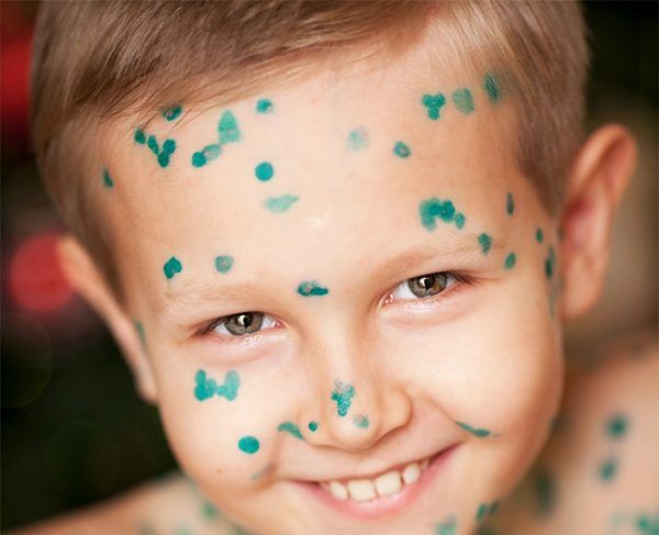 Болезнь ветрянка Болезнь ветрянка