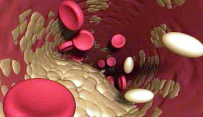 Лечение атеросклероза Лечение атеросклероза