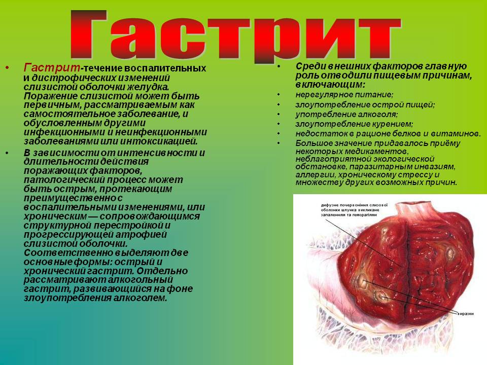 Лечение гастрита