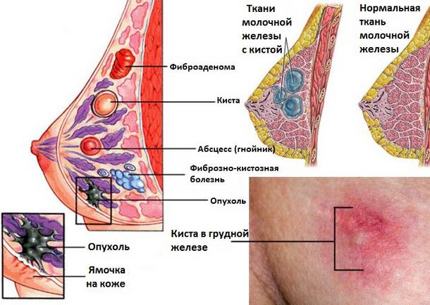 Лечение кисты Лечение кисты