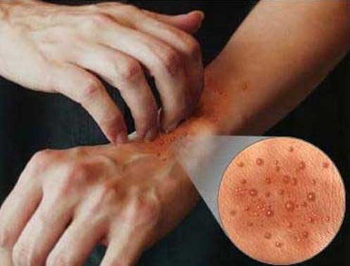 Лечение нейродермита