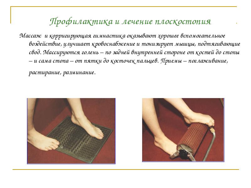 Плоскостопие лечение