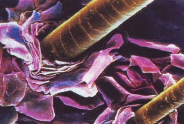 Причины появления перхоти Причины появления перхоти