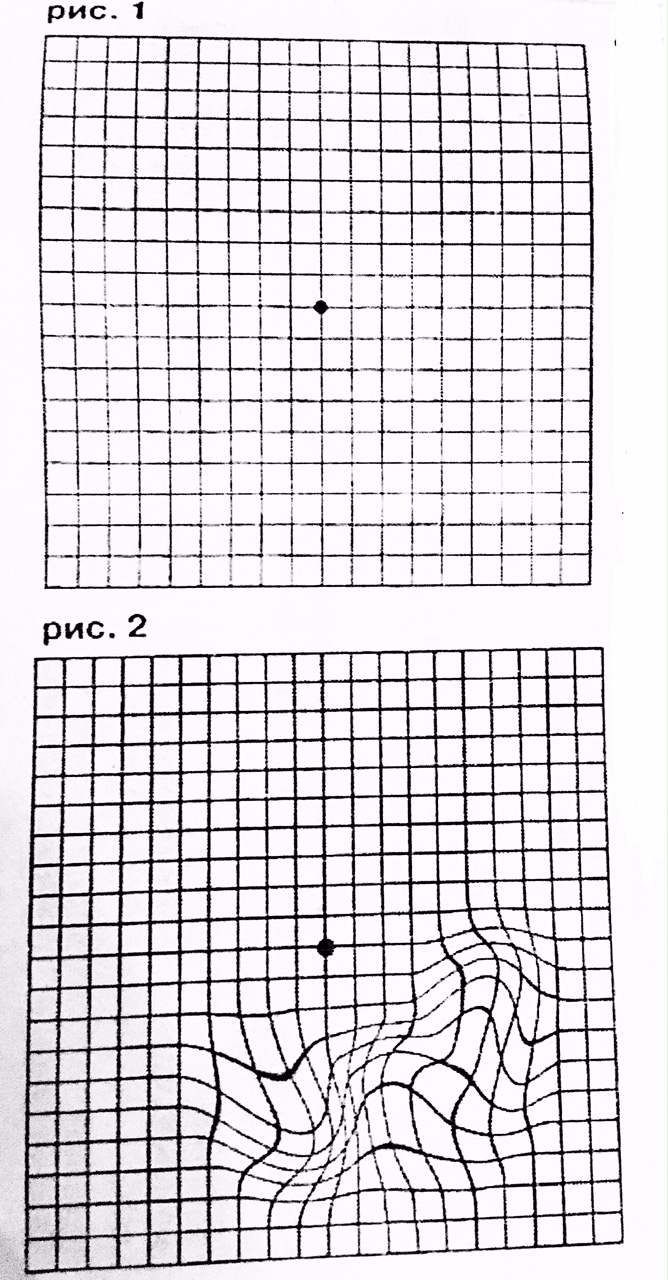Диагностика дистрофии сетчатки Проверка зрения