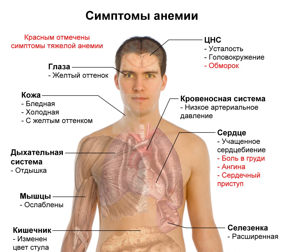 Симптомы заболевания крови анемия Заболевание анемия