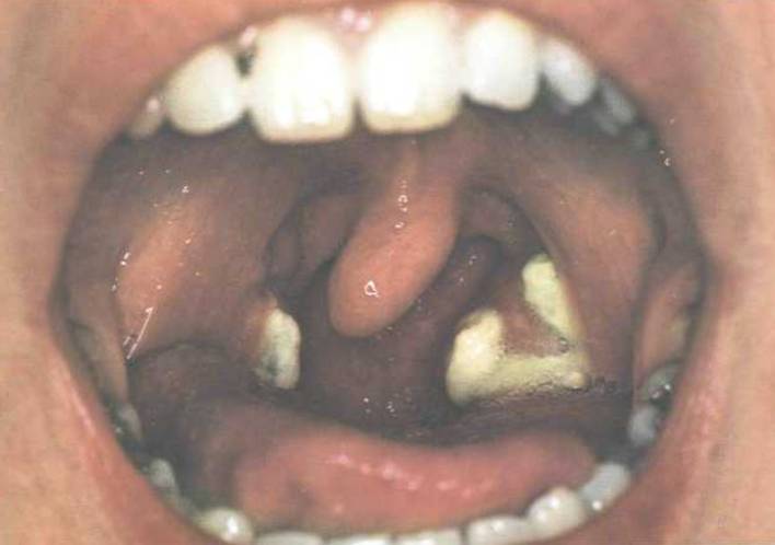 ангина при инфекционном мононуклеозе