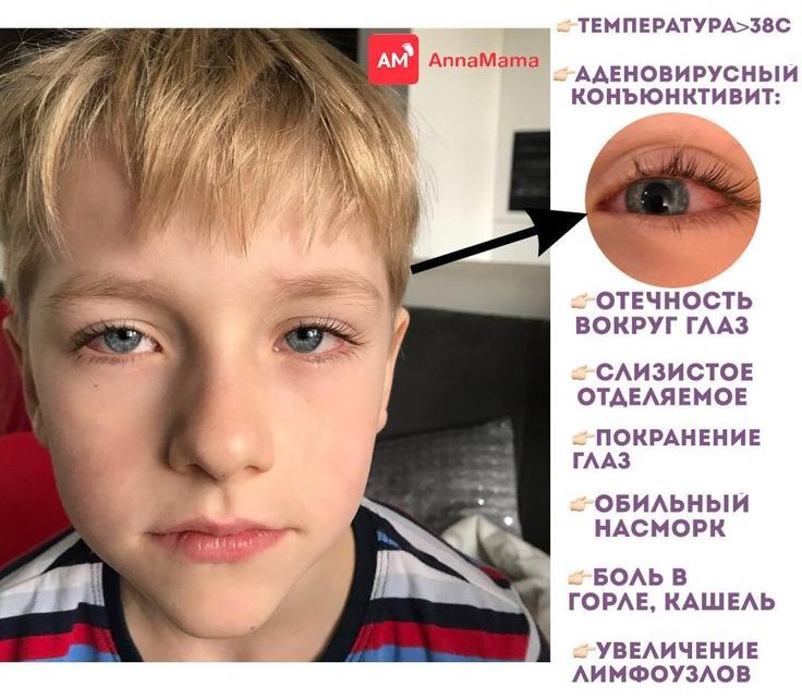 аденовирусный коньюктевит