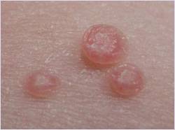 контагиозный моллюск фото