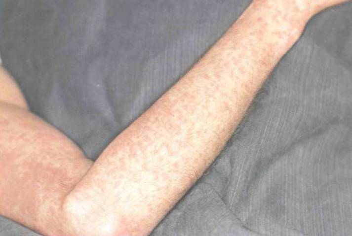 ангина при инфекционном мононуклеозе