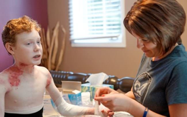 Буллезный эпидермолиз: что такое, основные симптомы, 3 вида, способы лечения, видео