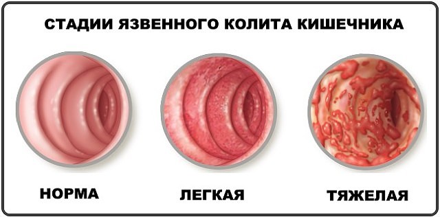 Энтероколит