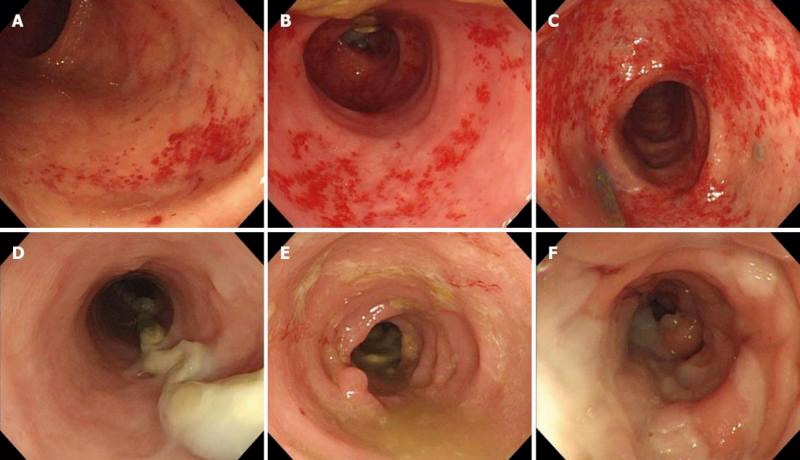 Энтероколит