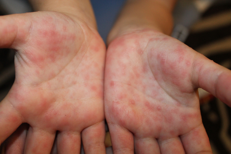 Энтеровирусы: типы, причины, симптомы