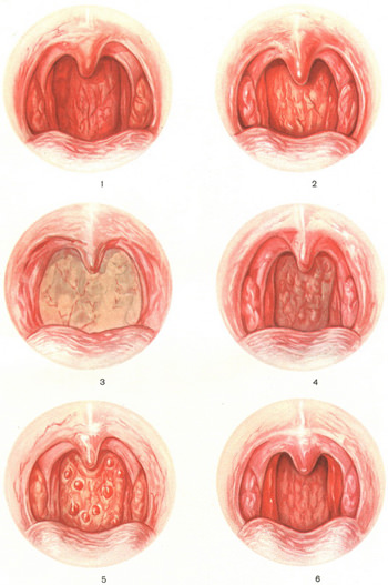 Фарингит: симптомы и лечение медикаментозное и народными средствами