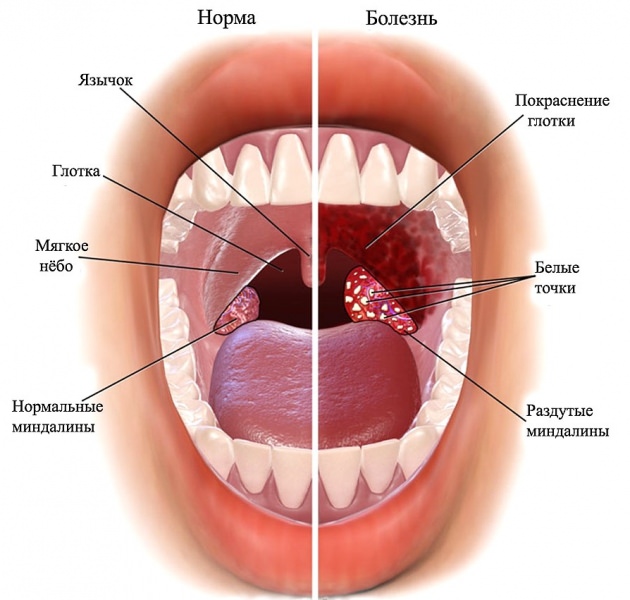 Фарингит: симптомы и лечение медикаментозное и народными средствами