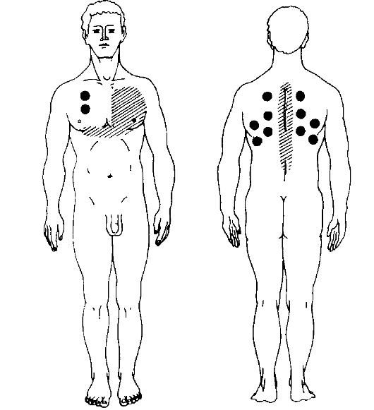 Горчичники на коже в проекции легких призваны улучшить кровообращение в органах дыхательной системы и победить кашель. Горчичники на коже в проекции легких призваны улучшить кровообращение в органах дыхательной системы и победить кашель.