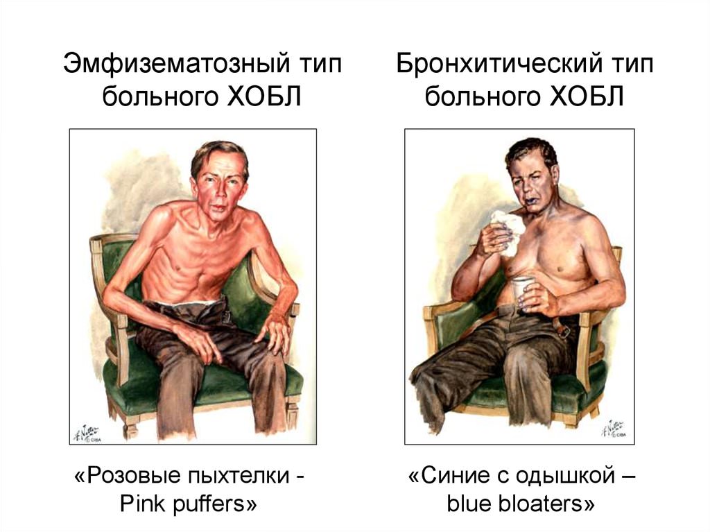 Характерный внешний вид пациентов Характерный внешний вид пациентов