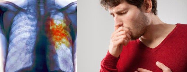 Кровотечение при заболеваниях легкого Кровотечение при заболеваниях легкого