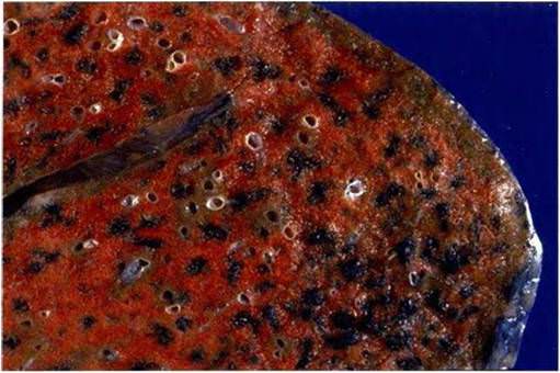 Макропрепарат: отмечается очаговая пигментация черного цвета Макропрепарат: отмечается очаговая пигментация черного цвета