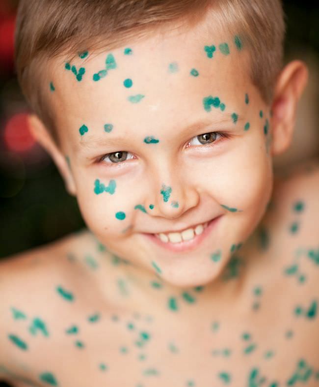 Осложнения после ветрянки возникают крайне редко Осложнения после ветрянки возникают крайне редко