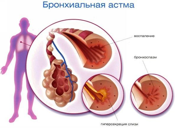 Патогенетические основы бронхиальной астмы Патогенетические основы бронхиальной астмы