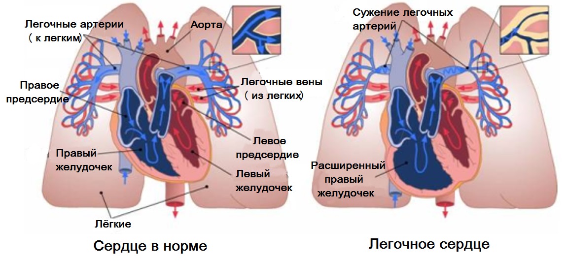 По мере прогрессирования в патологический процесс вовлекается сердечно-сосудистая система По мере прогрессирования в патологический процесс вовлекается сердечно-сосудистая система