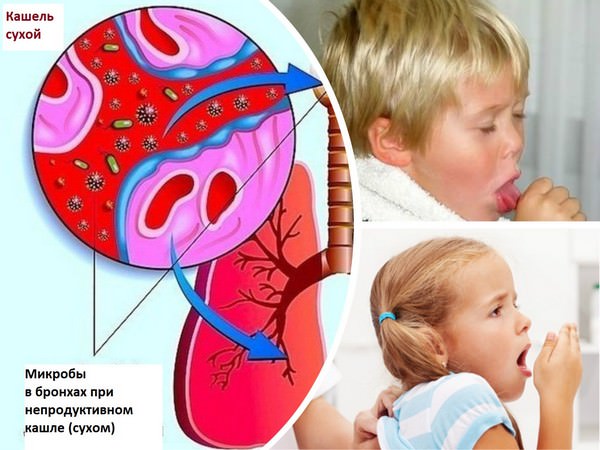 Пример скапливания микробов при кашле Пример скапливания микробов при кашле