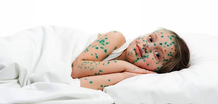 Ранки мажут растворами антисептиков для профилактики вторичного инфицирования Ранки мажут растворами антисептиков для профилактики вторичного инфицирования