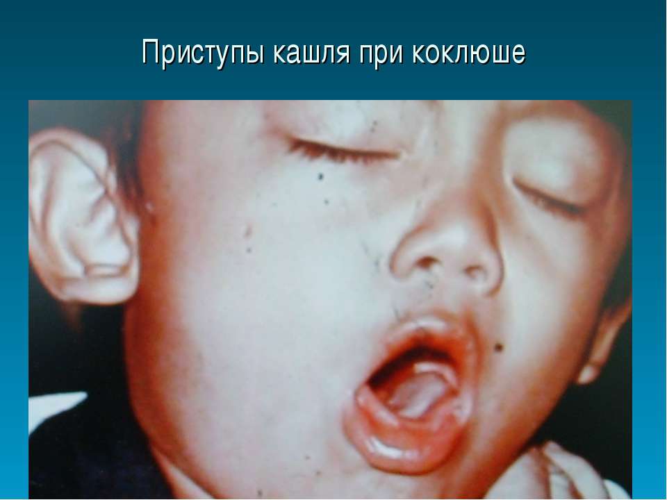 Свистящий кашель при коклюше Свистящий кашель при коклюше