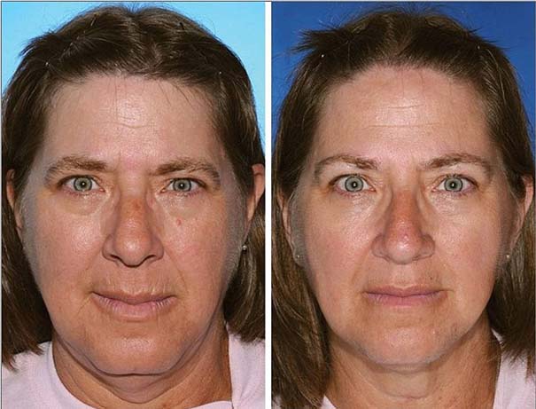 Влияние курения на кожу человека