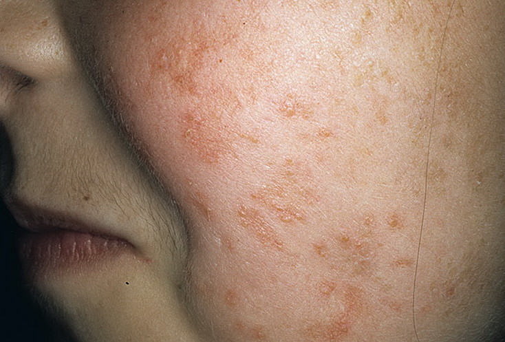 Вовлечение кожных покровов Вовлечение кожных покровов