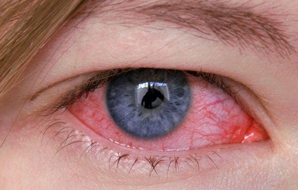 аденовирусный конъюнктивит