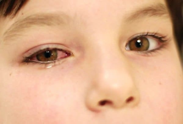 Аденовирусный конъюнктивит