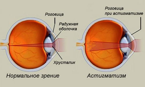 астигматизм глаз