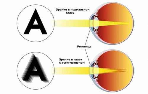 астигматизм глаз