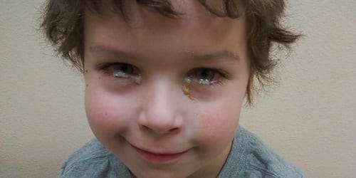 Бактериальный конъюнктивит у детей