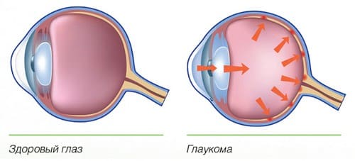 глаукома
