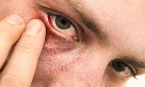 болезни глаз