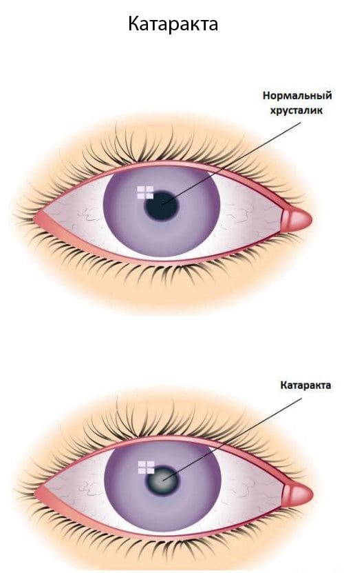 Катаракта причины, симптомы, лечение и профилактика