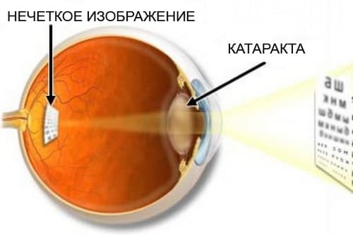 катаракта