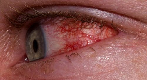 конъюнктивит у взрослых