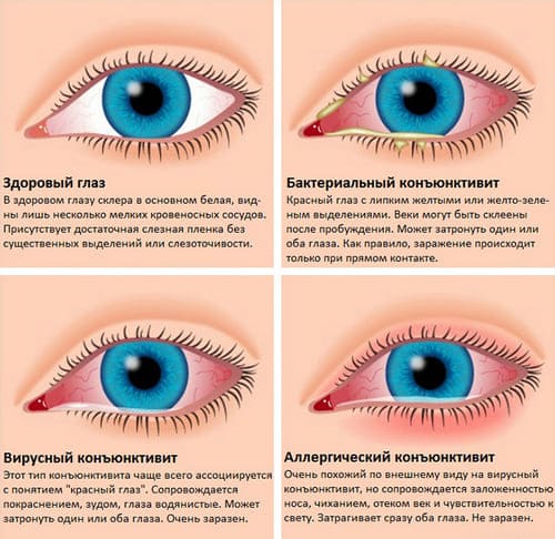 конъюнктивит