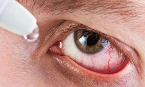 красные белки глаз