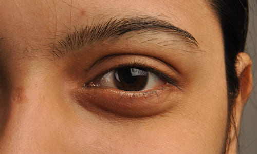 отеки, мешки под глазами