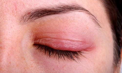 аллергический отек глаз