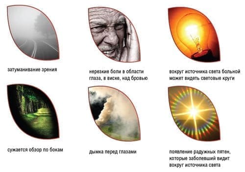 признаки острого приступа