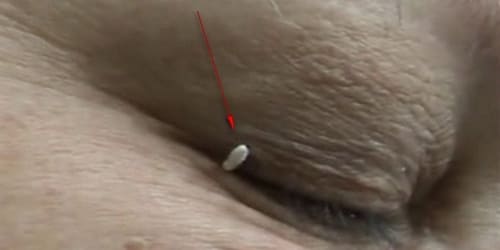 Папиллома на веке глаза