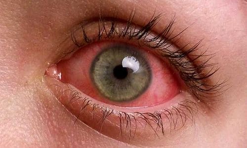 Вирусный конъюнктивит