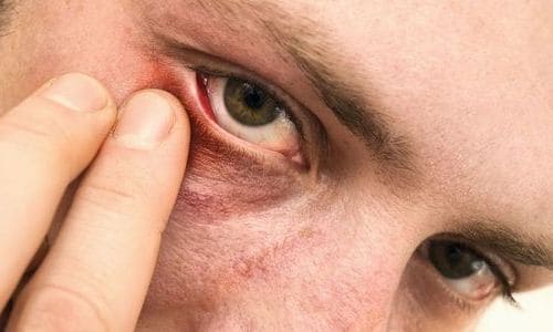 Вирусный конъюнктивит