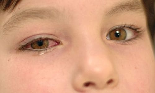 Вирусный конъюнктивит